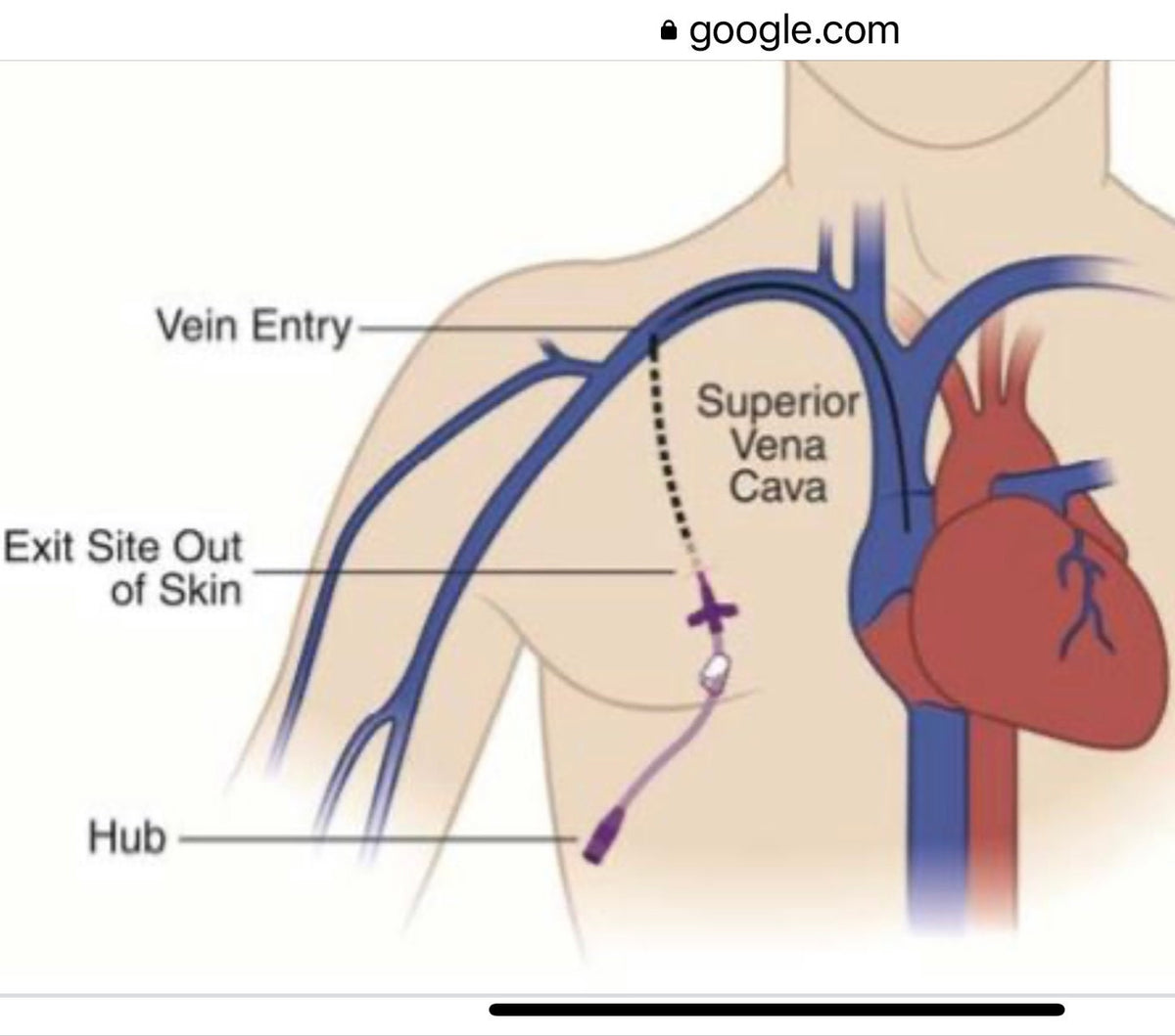Broviac, Hickman Line Cover|CVL |Short Central Line| Medical Connection Port Cover